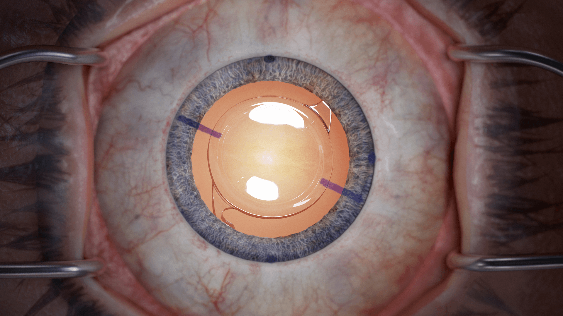 Intraocular lens seated in the capsular bag, rendered from the simulation