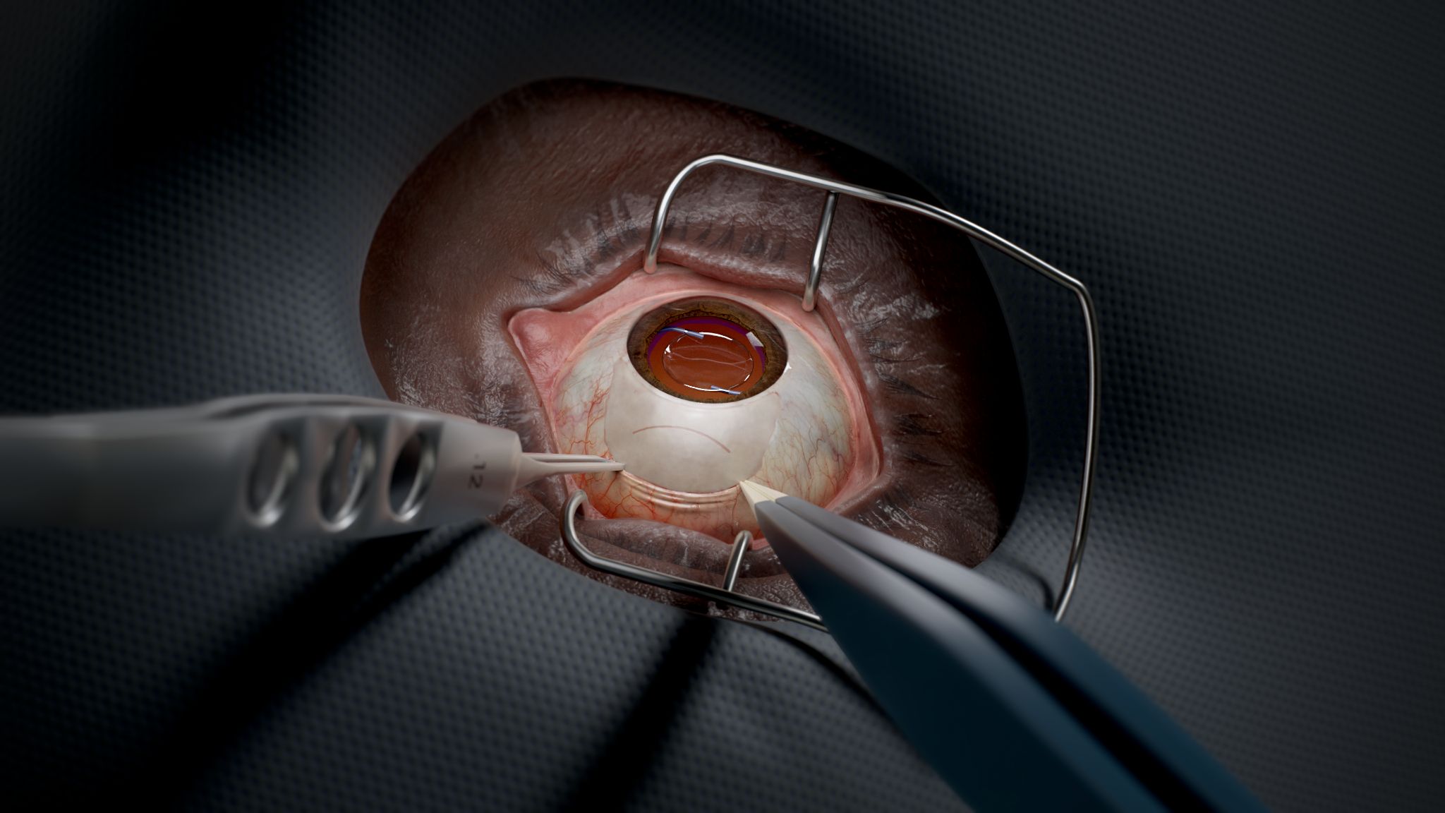 Close-up of ophthalmic surgery with instruments positioned at the eye