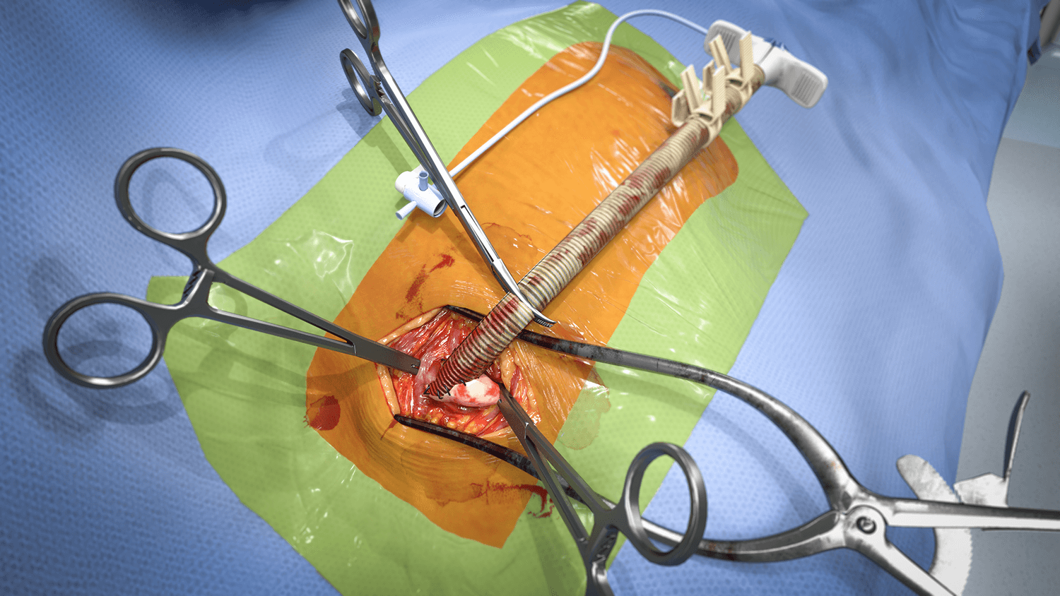 Catheter-based endovascular procedure rendered from the simulation
