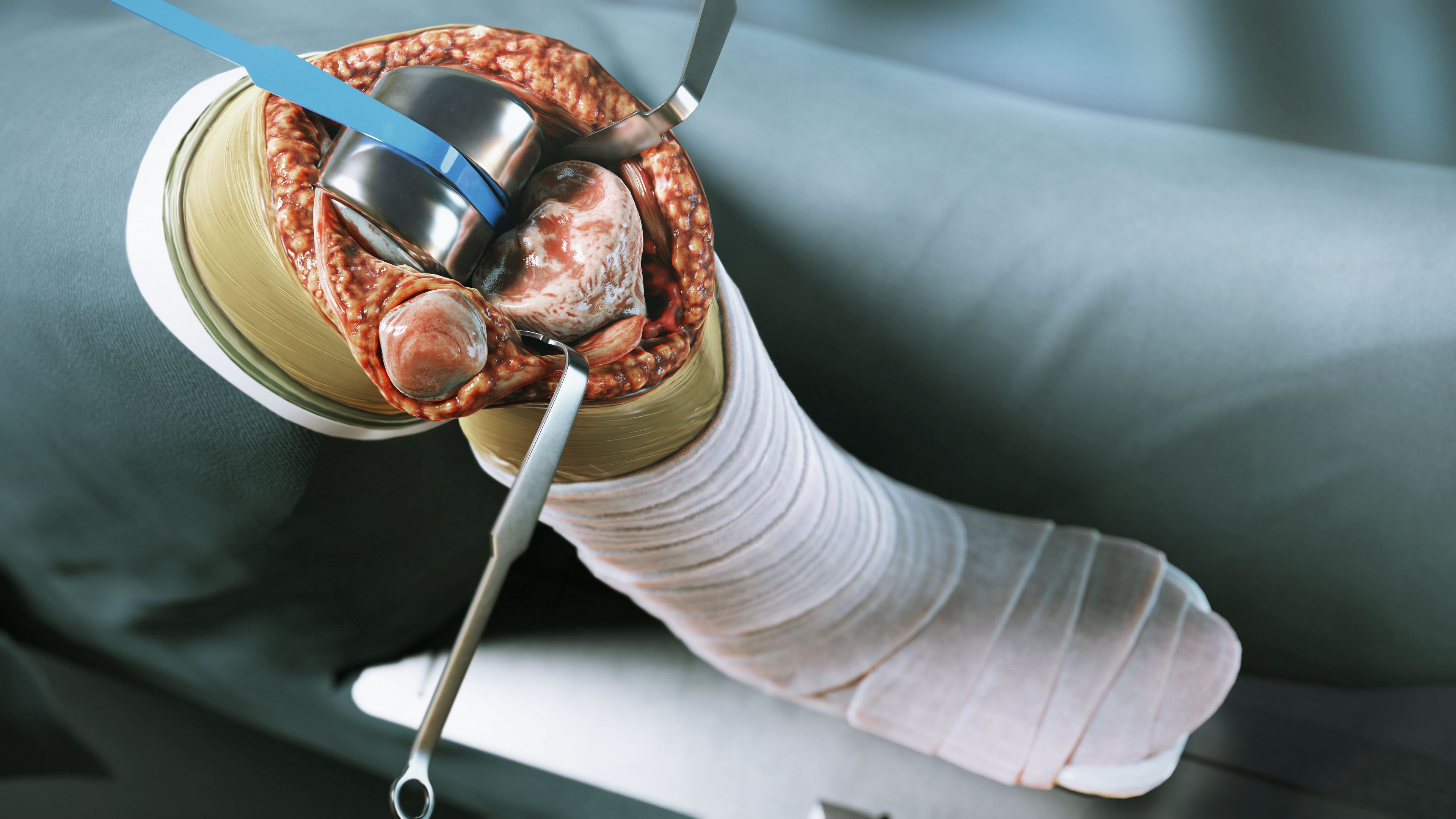 Total knee arthroplasty render showing implant components seated in the joint with surgical retractors